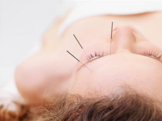 how facial acupuncture can improve the look of your skin